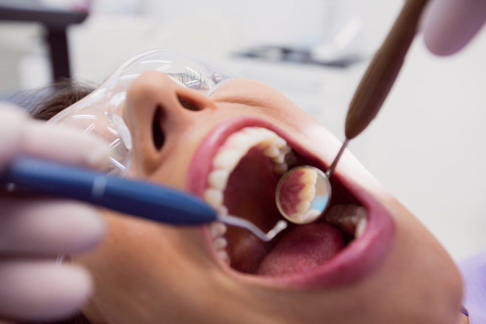 Tooth-Colored Fillings