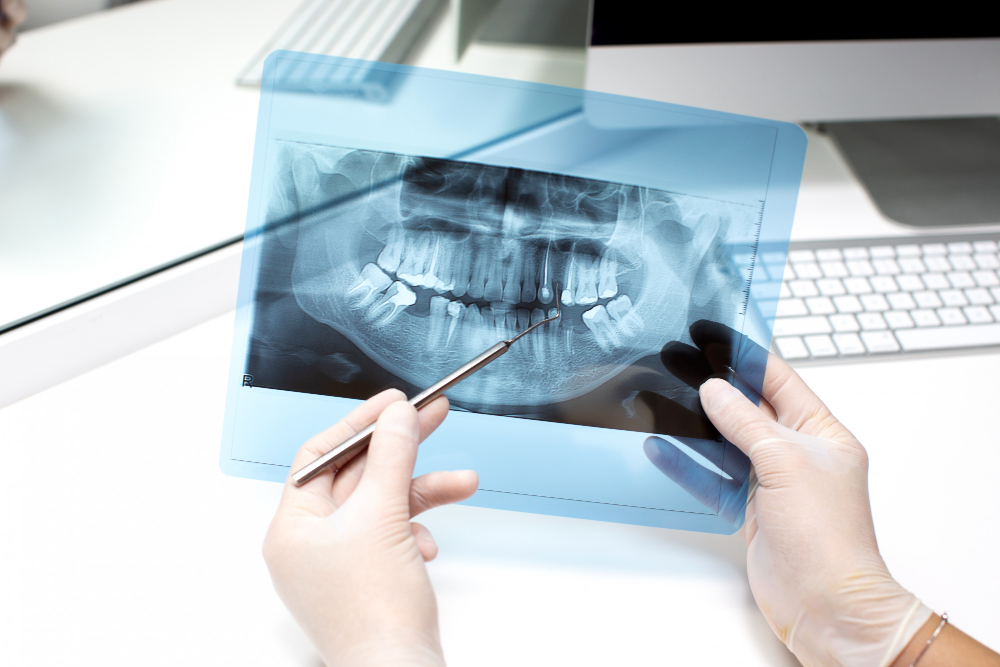 Digital X-Rays & RVG